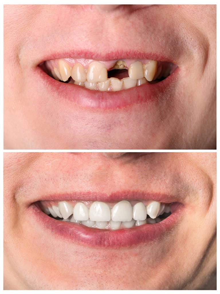 Before-and-after-of-a-incisive-tooth-restoration-treatment