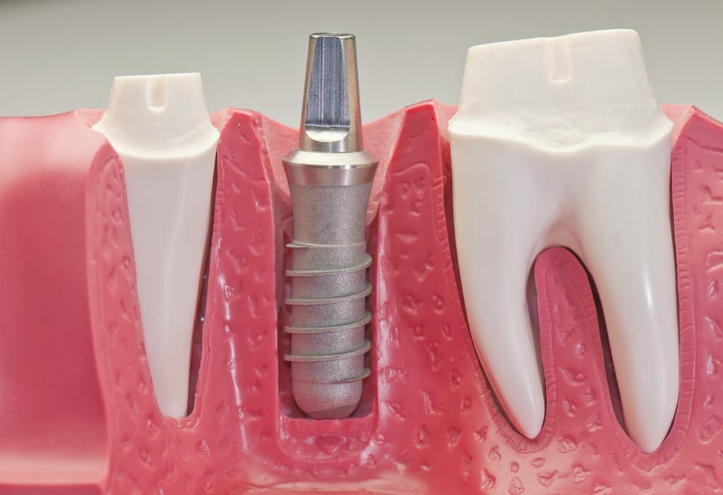Dental-Implant-Model