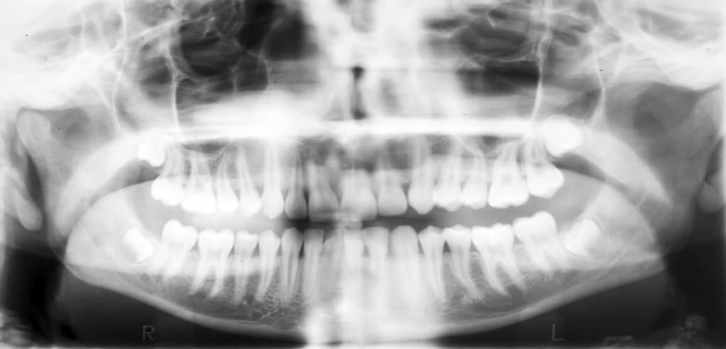 X-ray-of-the-oral-cavity