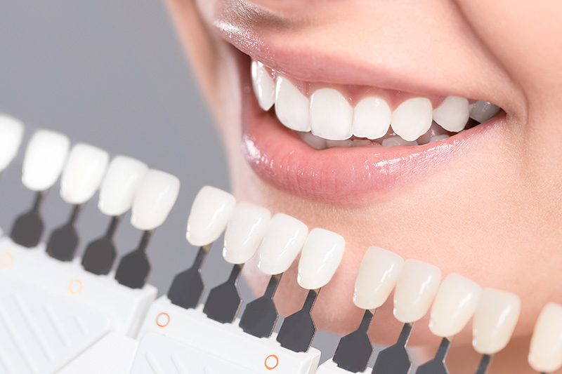Teeth bleaching