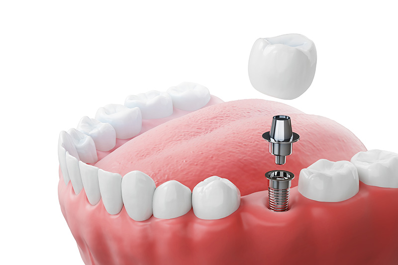 Single tooth dental implant