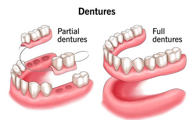 Dentures Denture types