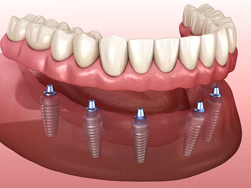 Implant retained dentures