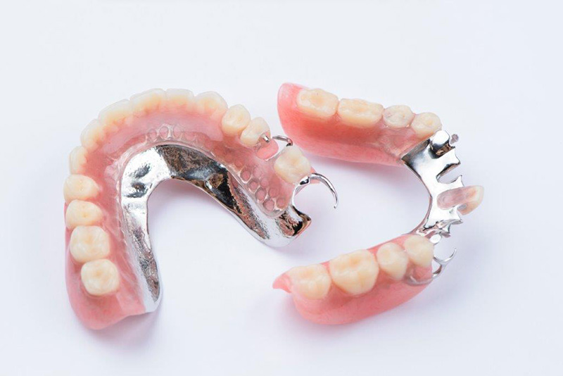 Removable partial denture