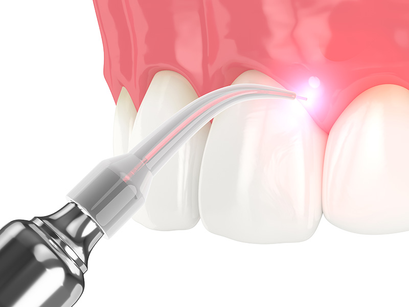 Soft tissue laser