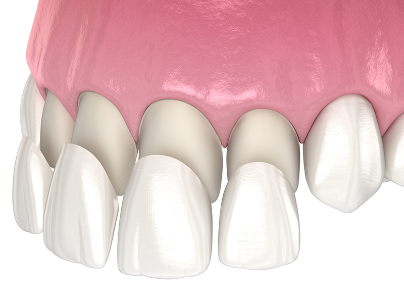 Veneers